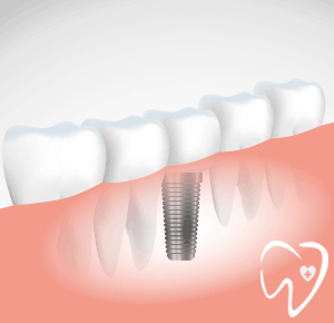 Oferta Implante dental Santander